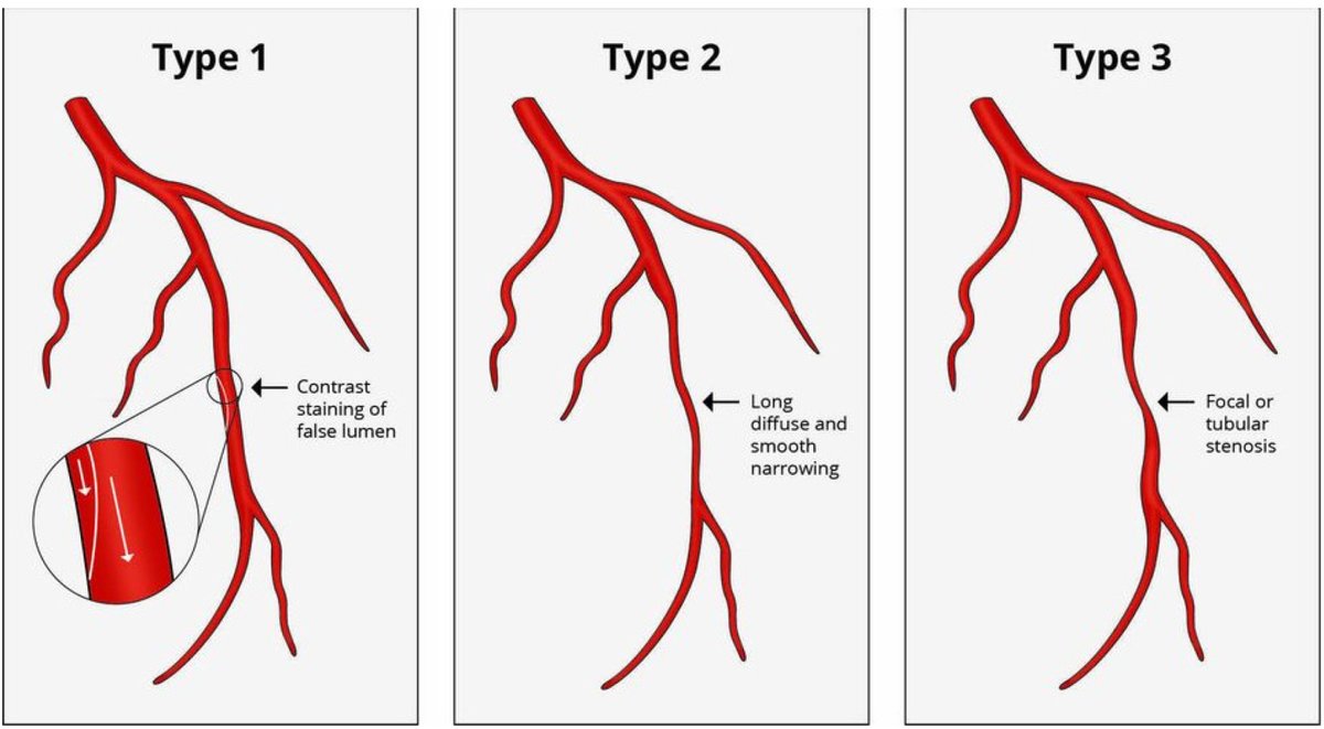 #RCM - Vol. 23 No. 11
🌷Systematic Review
Myocardial Infarction with Non-Obstructive Coronary Arteries: A Puzzle in Search of a Solution

#MyocardialInfarction #MINOCA #etiologies #pathophysiology #diagnostic #therapeutic #CAD

Full text:
imrpress.com/journal/RCM/23…