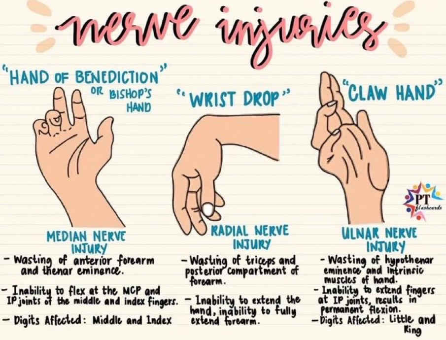 Nerve injuries by PTflashcards #Medtwitter
