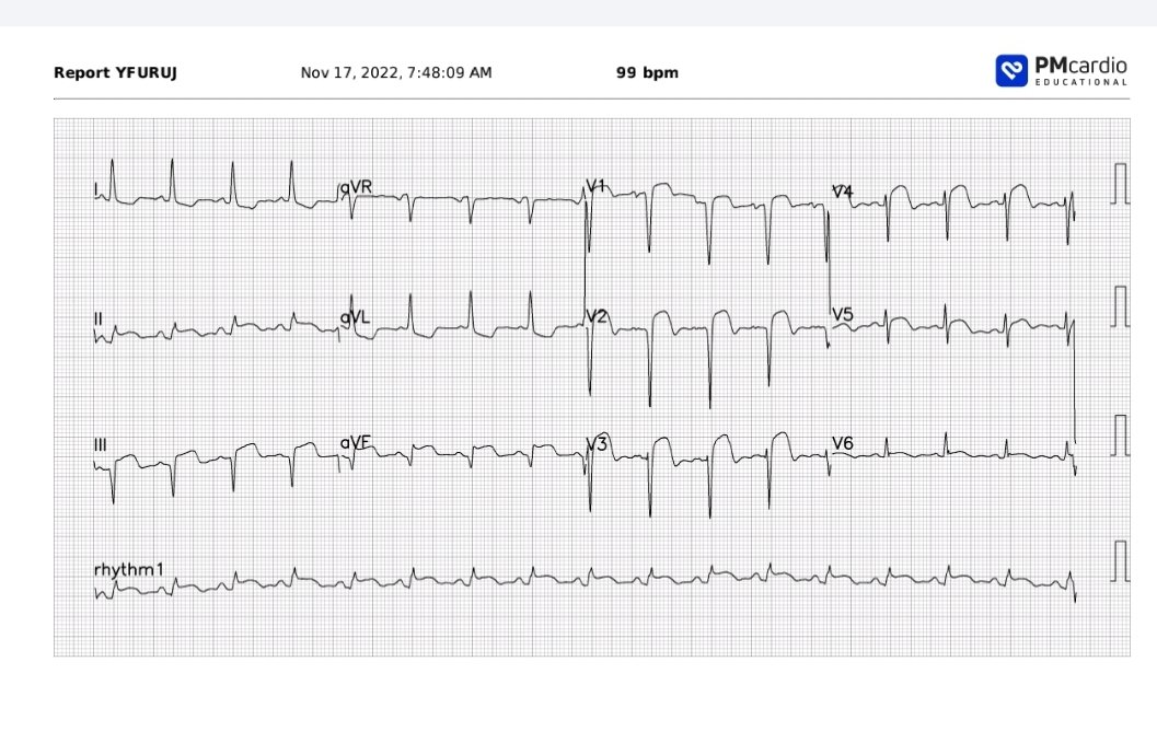 kulinsheth's tweet photo. Interesting - what's going on here? History - 62/F, HTN, chest pain since 8 hours. Vitals Ok. What's happening and what's to blame? @ecgrhythms @ecg_cases @EkgHacks
#FOAMed #CardioTwitter #ecgcases https://t.co/Ks87Sq9mgm