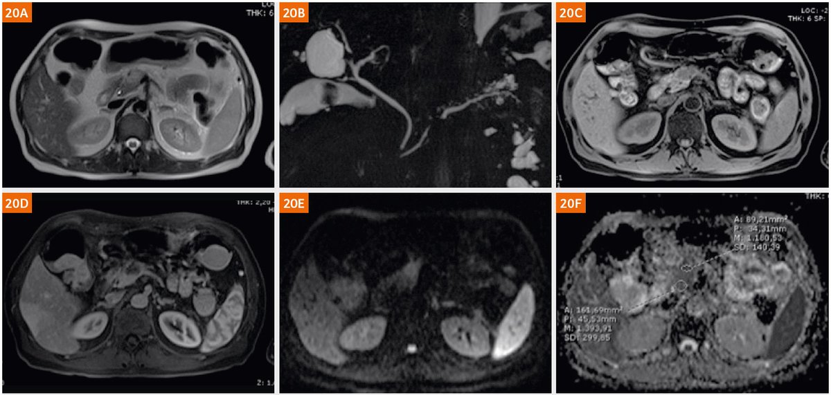 On #WorldPancreaticCancerDay let me draw your attention to “Imaging of the Pancreas: Technique and Clinical Applications” by Giovanni Morana, MD; et al. (General Hospital Ca’ Foncello, Treviso, Italy). …ng.webassets.siemens-healthineers.com/18000000043972…
#magnetomworld #MRI #pancreas