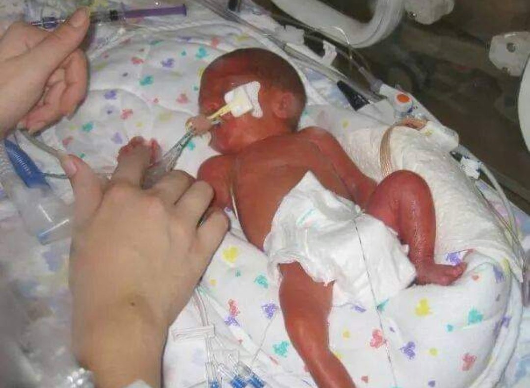 RebeccaLemin (@rebeccalemin) on Twitter photo Celebrating World Prematurity Day and sending love to all families currently in Nicu in the @swneonatal. Forever grateful to <a href="/NHSEngland/">NHS England</a> <a href="/NorthBristolNHS/">North Bristol NHS Trust</a> <a href="/Blisscharity/">Bliss Baby Charity</a> for my 25 wkers 14 yrs ago and the ongoing care from <a href="/uhbwNHS/">University Hospitals Bristol and Weston NHS FT</a> #wpd2023 #WorldPrematurityDay Celebrating World Prematurity Day and sending love to all families currently in Nicu in the @swneonatal. Forever grateful to <a href="/NHSEngland/">NHS England</a> <a href="/NorthBristolNHS/">North Bristol NHS Trust</a> <a href="/Blisscharity/">Bliss Baby Charity</a> for my 25 wkers 14 yrs ago and the ongoing care from <a href="/uhbwNHS/">University Hospitals Bristol and Weston NHS FT</a> #wpd2023 #WorldPrematurityDay