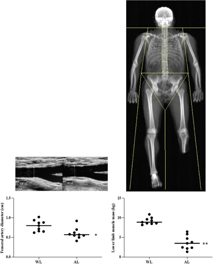 The role of muscle mass in vascular remodeling: insights from a single-leg amputee model Anna Pedrinolla et al @UniVerona #openaccess #vascularremodeling #amputee rdcu.be/cZRX2