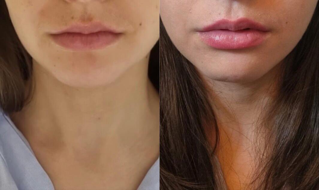 DrTijionEsho's tweet photo. No needles. Subtle. Safe. Natural. 
.
The ESHO New 24hr lip kit available from from our website now ! 
.
Contains :

ESHO DRENCH 12ML - HYDRATE
ESHO RENEW.  12ML - EXFOLIATE 
ESHO SEAL.  12ML - MASK
.
( Add ESHO Sculpt for a volume boost ! )
.
#lipboss #lipbooster #lipbalm https://t.co/KcUJLHYcUc