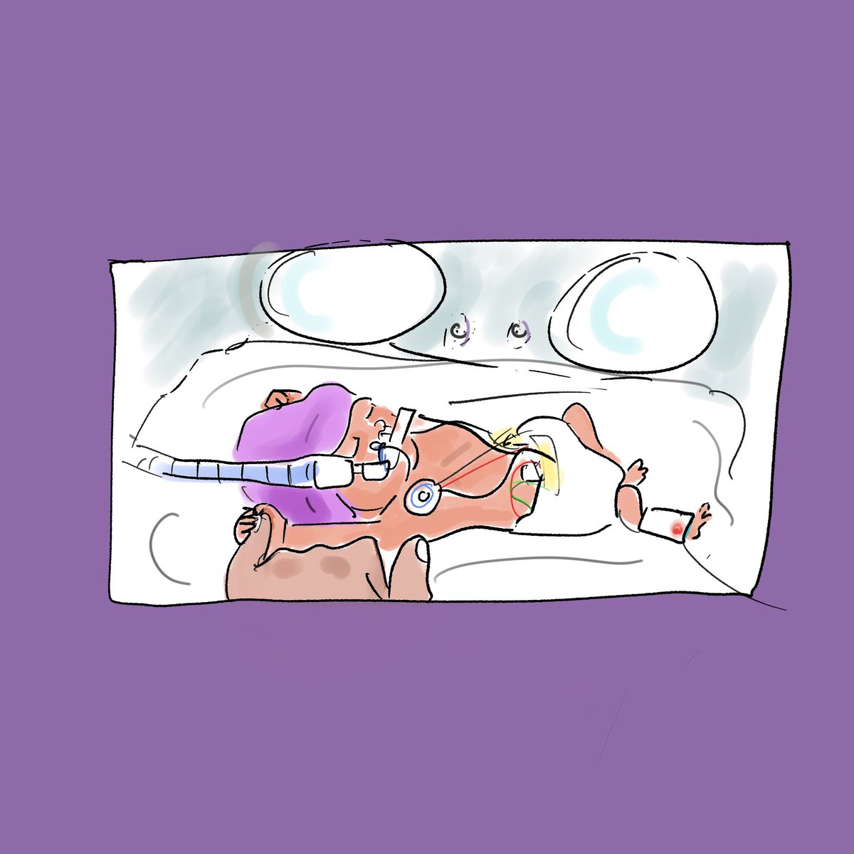 On #WorldPrematurityDay I want to send heartfelt thanks and love to the miracle workers <a href="/ImperialNHS/">Imperial NHS 💙</a> #QueenCharlottes #NICU for their pioneering work and incredible care <a href="/DeierlA/">Aniko Deierl</a> <a href="/JayBanerjeeNeo/">Jay Banerjee</a> <a href="/cosmiccharity/">COSMIC</a> <a href="/Blisscharity/">Bliss Baby Charity</a> #familyintegratedcare