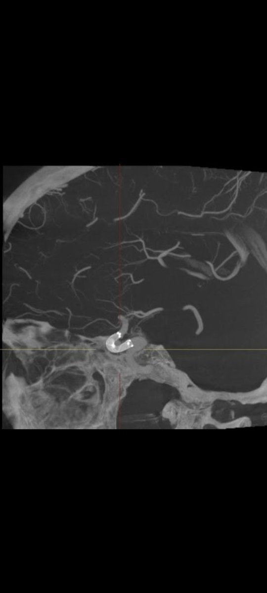 Una vez implantado, se hace control con 3D y CBCT y analizar la correct@a implantación del dispositivo
