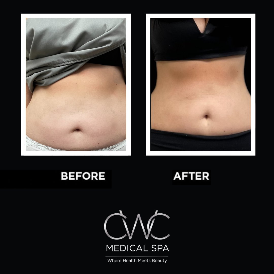 #EMSCULPTNEO🔥

✔️ non-invasive treatment
✔️ no downtime
✔️ one session takes 30 minutes

Call today! 586-307-2109

#emsculpt #bodycontouring #bodysculpting #bodybybtl #btlaesthetics #bodyshaping #explorepage #medspa #results #bodygoals #beforeafter #michiganmedspa