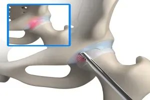 AmericanHipInst's tweet photo. Trauma to the hip, chronic overuse or anatomical abnormalities can all cause hip #labraltears. Fortunately, procedures like #labraldebridement can address this condition & allow you to return to your sport, occupation or daily activities. #AHI #drdomb https://t.co/Sza8kfI5uH https://t.co/ZbcftNpXKf