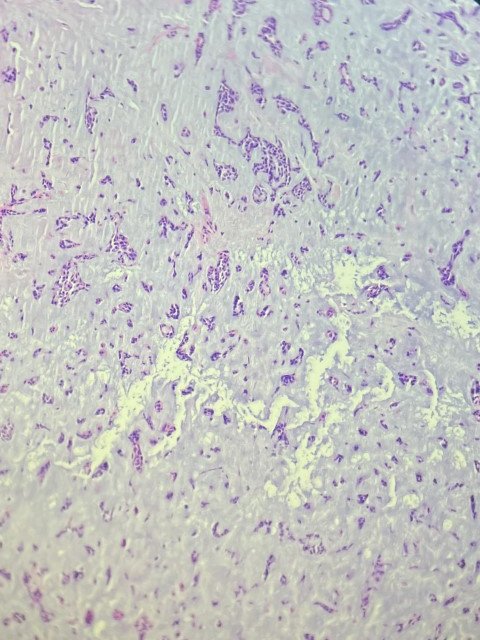 megothelioma's tweet photo. They don't call them "pleomorphic" adenomas for nothing - widely variable morphology in these two cases. One more stroma-rich and one more compactly cellular.
#PathTwitter #basicpath https://t.co/2hHIGDIAD4