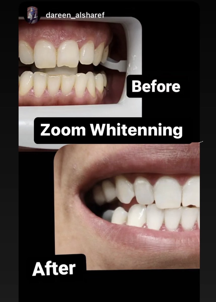 toothcorner's tweet photo. Zoom whitenning at The Tooth Corner before and after #dentistry #toronto https://t.co/9l7V7kv2HR