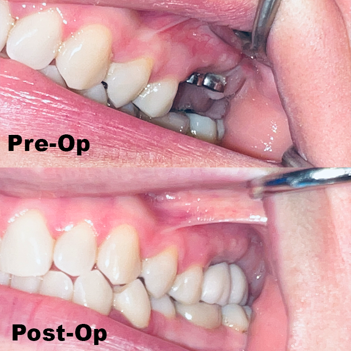 cdic_dmd's tweet photo. Maria came to our office with missing  #4, #14 and #15 teeth. We recommended implant retained restoration for these areas. It took us a total of twelve weeks to complete our treatments and here are the stunning results! Patient is super happy. https://t.co/4WA5p9Ip8h
