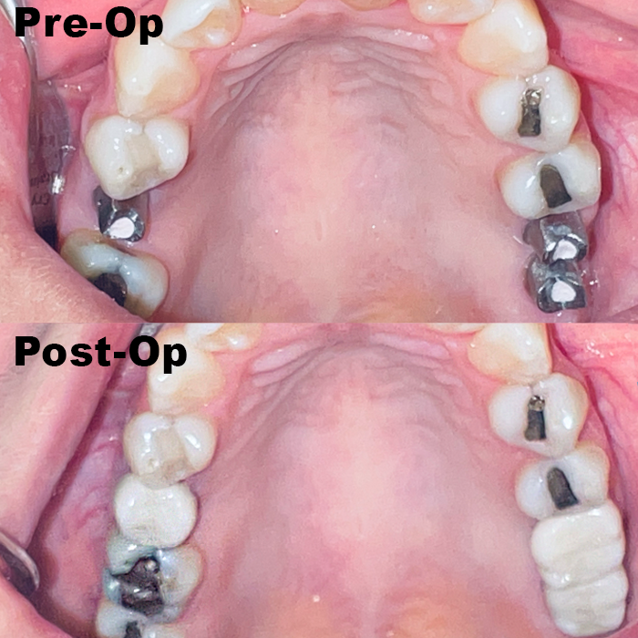 cdic_dmd's tweet photo. Maria came to our office with missing  #4, #14 and #15 teeth. We recommended implant retained restoration for these areas. It took us a total of twelve weeks to complete our treatments and here are the stunning results! Patient is super happy. https://t.co/4WA5p9Ip8h