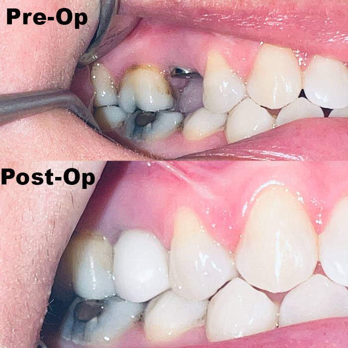 cdic_dmd's tweet photo. Maria came to our office with missing  #4, #14 and #15 teeth. We recommended implant retained restoration for these areas. It took us a total of twelve weeks to complete our treatments and here are the stunning results! Patient is super happy. https://t.co/4WA5p9Ip8h