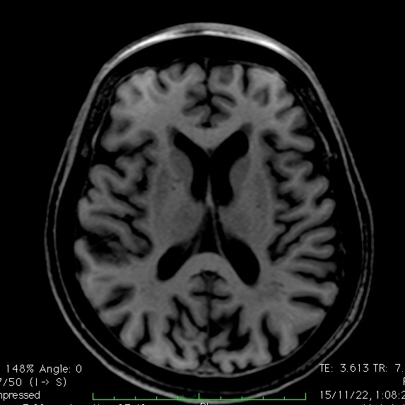 #neurotwitter #Neurology #neuroradiology #dementia #stroke #AmyloidAngiopathy #BostonCriteria #CAA 
@a_charidimou 81 y old female with transient right hemiparesis and dysarthria less than 48 hr. No headaches. No previous AD or stroke. Is this a probable or possible CAA case?