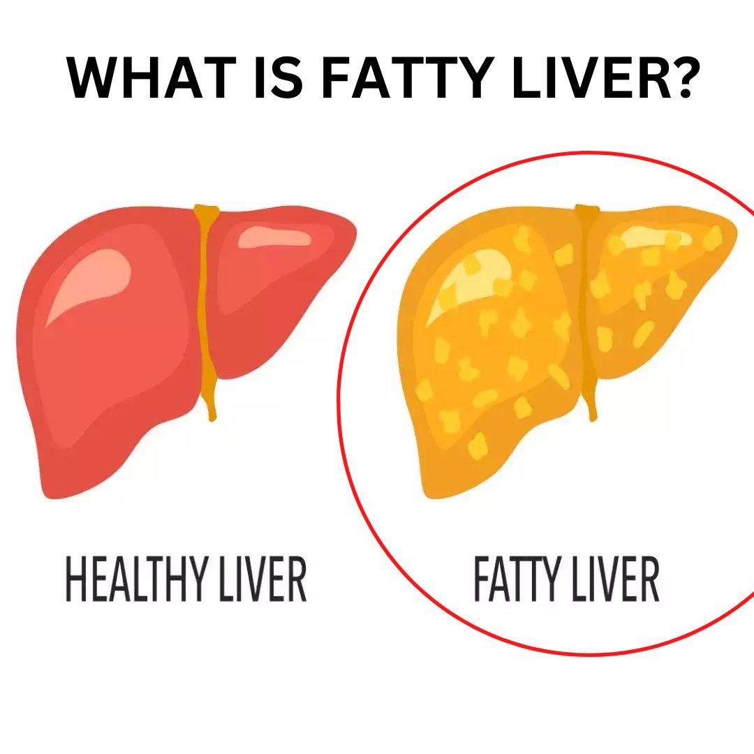 thinkyou_1's tweet image. REVERSAL OF FATTY LIVER IS POSSIBLE WITH THE HELP OF THINKYOU’S SCIENTIFIC DIET PLAN.

Check our latest blog of Fatty Liver - thinkyou.in/fatty-liver-di…

#thinkyou #thinkyoudiet #fattyliver #fattyliverdiet #livercause #healthyliver #unhealthyliver #healthydiet #staysafe #stayhealthy