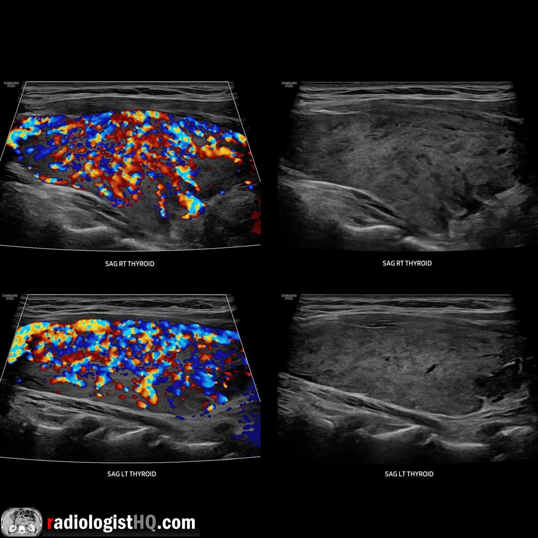 Graves’ disease. Enlarged thyroid gland with heterogeneous echotexture. Marked hypervascularity yielding a “thyroid inferno” appearance. An autoimmune disease, more common in females, and most common cause of hyperthyroidism. 
#FOAMrad #radres #radtech #medstudent #radiologisthq