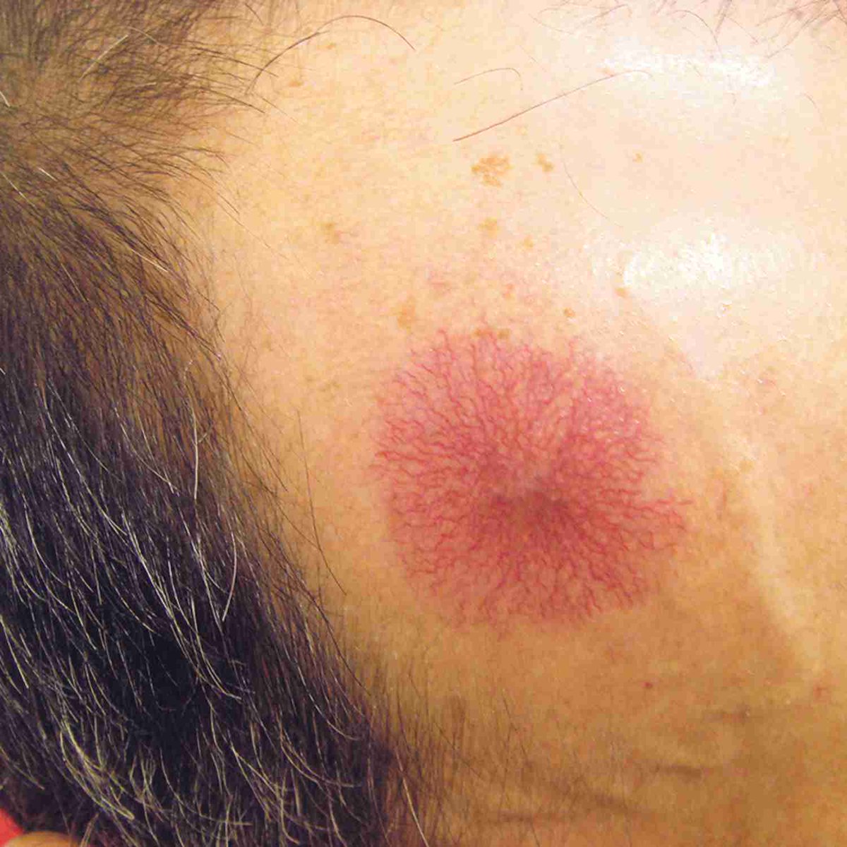 BrownJHM's tweet photo. A 62-year-old man presented for evaluation of elevated LFTs. He was noted to have a lesion on his face. Compression caused the entire lesion to blanch, and it quickly refilled once the compression was released. What is the most likely underlying diagnosis? #Medtwitter https://t.co/C4ogvWd35W