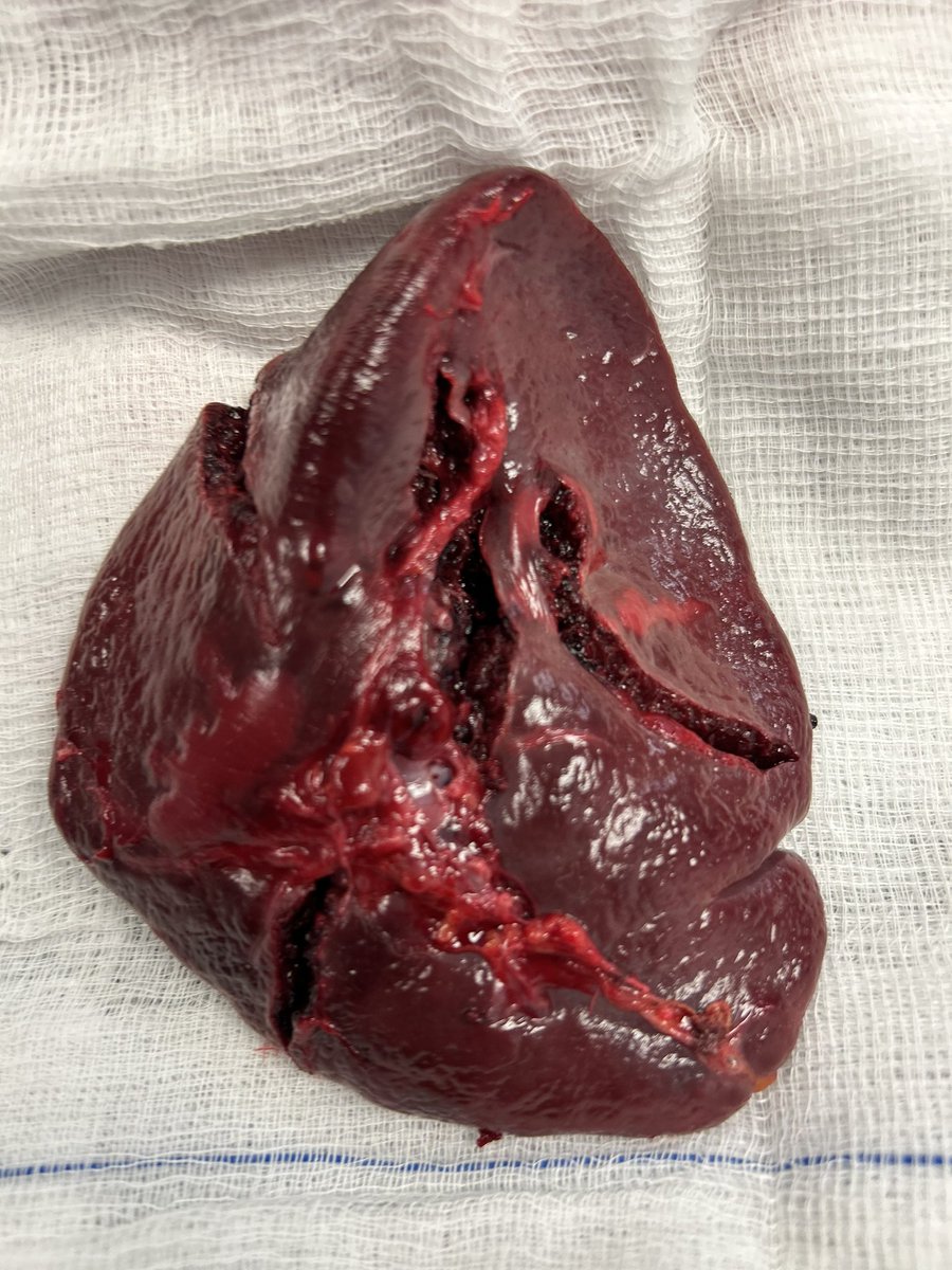 1. What’s organ is this? 2. What surgery has been performed 3. What is the commonest indication for this surgery? 4. Name five other indications for this procedure? 5. What is the most feared late complication and how is this prevented? Small token for the first correct answer