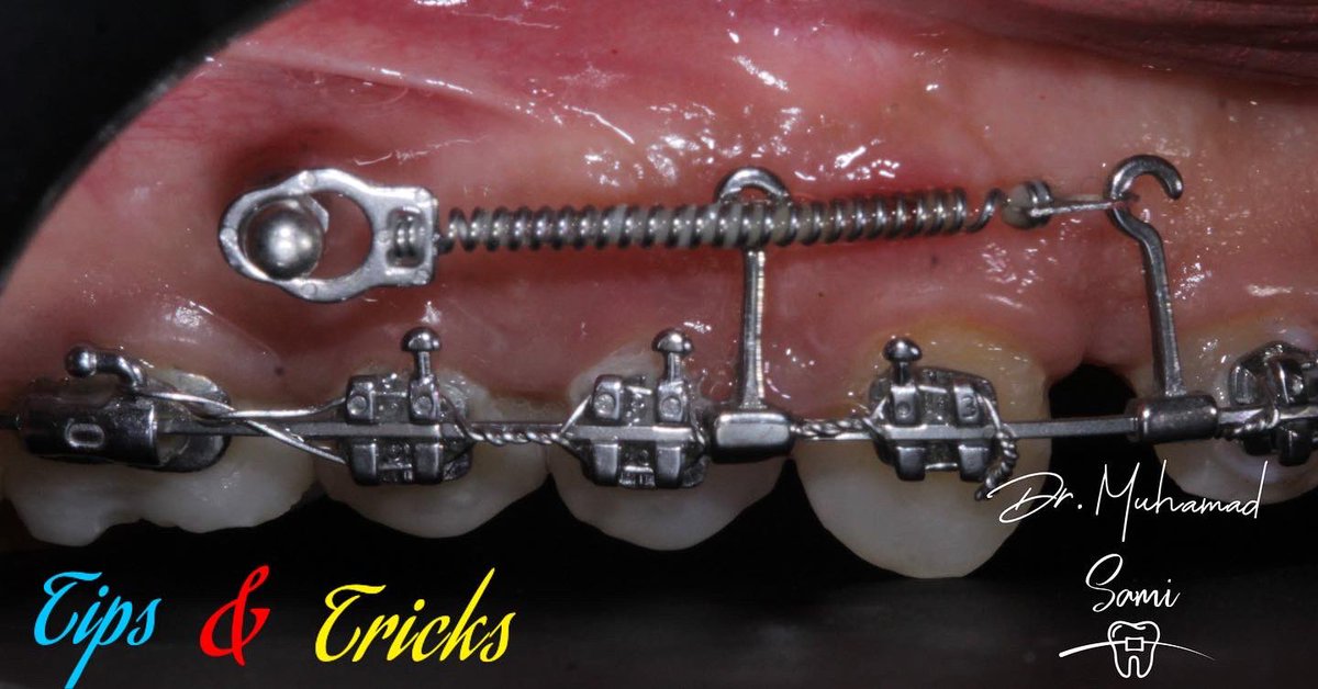 Muhamadsamii's tweet photo. Tips &amp; Tricks 🥰😎 
Using Niti Closing coils has some Disadvantages 🤔
Like it’s may be Painful for the patient due to continuous force 
That may lead to some ulcers &amp; gingival hyperplasia ………….. https://t.co/9M0ItRJsrl