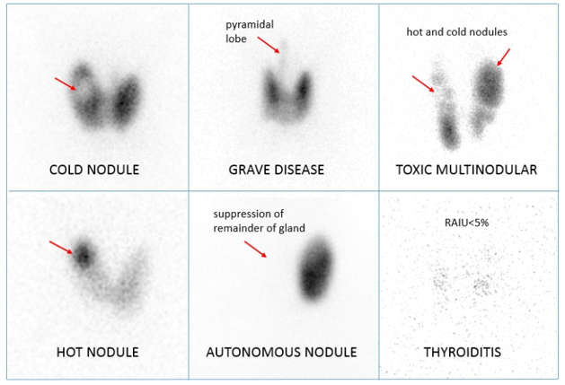 TheAAES's tweet photo. Graves' disease is the most prevalent autoimmune disorder in the US and the cause of 60-80% of all cases of hyperthyroidism. It is much more common in women and can affect any age. #GravesDiseaseAwarenessMonth #GravesDisease #GDAM2022
@GDATF @AmThyroidAssn @TheAACE https://t.co/mIaeqO1yK7