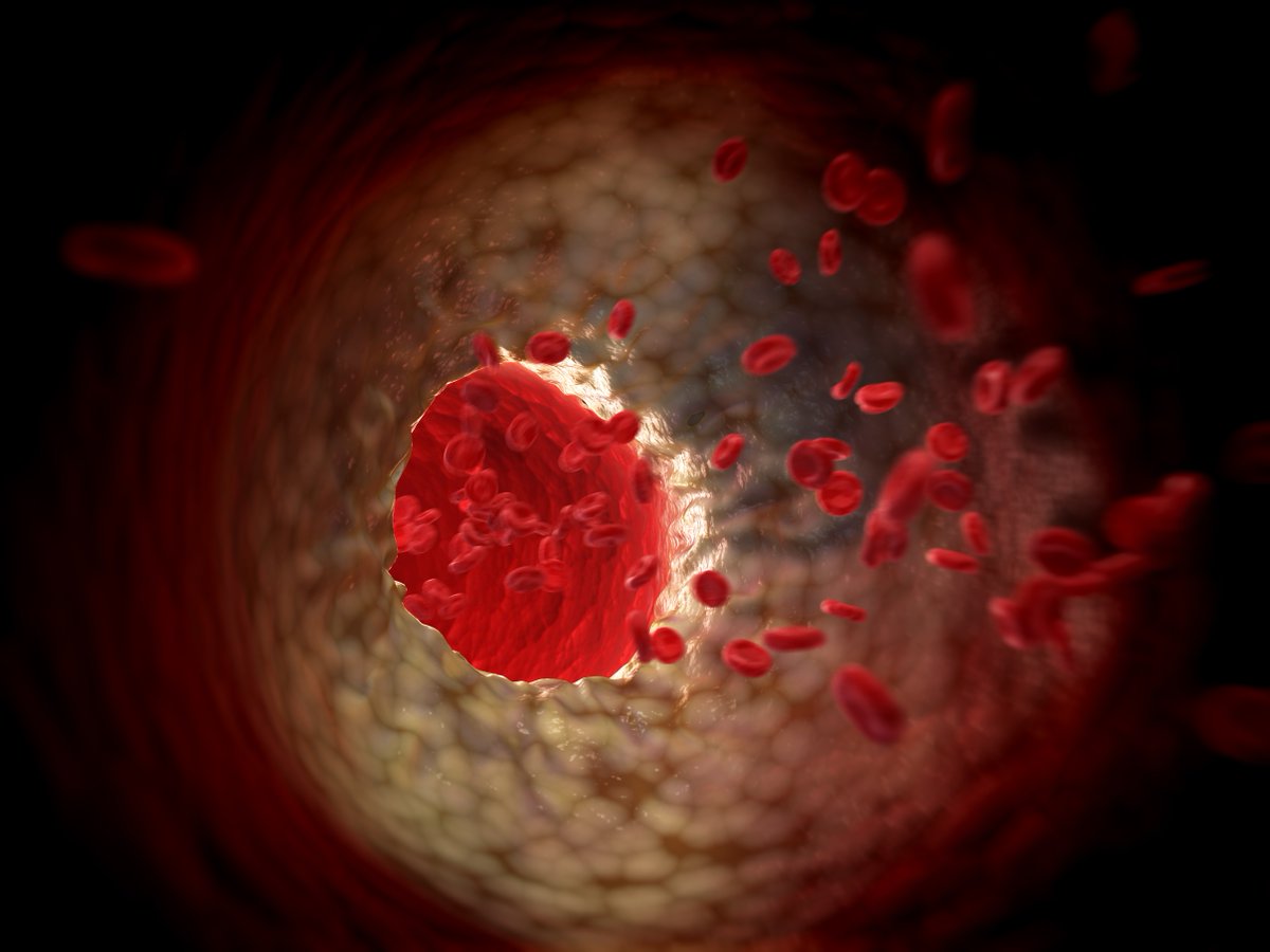 theheartorg | Medscape (@theheartorg) on Twitter photo With targeted therapies on the horizon <a href="/DrM_ODonoghue/">Michelle O'Donoghue</a> & <a href="/ProfSNicholls/">Steve Nicholls</a> discuss Lp(a) and its role in #ASCVD #AHA22 ms.spr.ly/6010eD8Zo With targeted therapies on the horizon <a href="/DrM_ODonoghue/">Michelle O'Donoghue</a> & <a href="/ProfSNicholls/">Steve Nicholls</a> discuss Lp(a) and its role in #ASCVD #AHA22 ms.spr.ly/6010eD8Zo