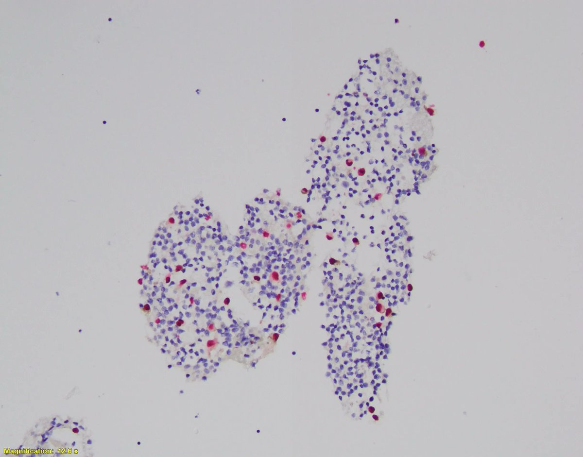 Today's #UABCyto case: 73 y/o M with a gastric mass. FNA shows a cellular specimen with discohesive pleomorphic cells with prominent nucleoli and some cytoplasmic pigment. Positive Sox-10 confirming the diagnosis of metastatic melanoma (from a scalp primary). Brooke Bartow PGY2