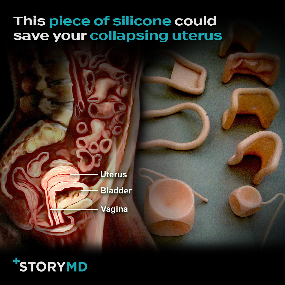 StoryMDHealth's tweet image. The biggest barrier to pelvic prolapse treatment is the misconception that they’re an inevitable part of aging. Learn how pessaries are plugging the leak. #Prolapse #Pessaries #WomensHealth #StoryMD #StoryMDHealth str.md/6EV689