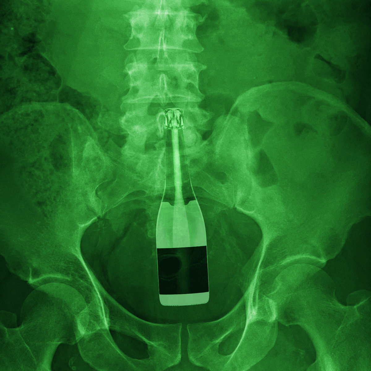 A Venezuelan man needed emergency surgery after bottle became stuck in his backside.
The man claimed the bottle was shoved up his anus by thieves who tried to rob him.
He said three men broke into his home and became angry when they could not find any valuables.
#NFT #truestory