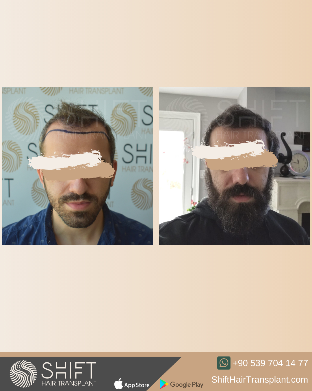 SHIFT Hair Transplant on Twitter: SHIFT Hair Transplant on Twitter: