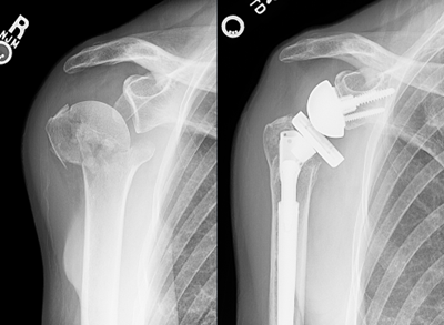 Reverse total shoulder replacement is increasingly used as a reliable treatment option for complicated fractures of the shoulder.

#ASES #Shoulder #OrthoTwitter