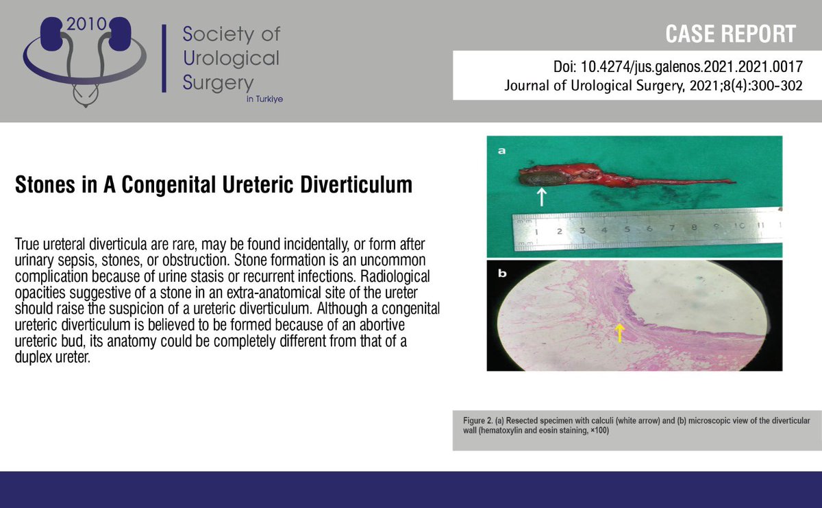 JUsurgery's tweet photo. Stones in A Congenital Ureteric Diverticulum
 
You can see the free full text of the research by Oshan Basnayake et al.
 
Link : https://t.co/X2Ev7tt5RM
 
#Ureteraldiverticulum #calculi #uretericduplication #urinarystones https://t.co/E9uaOMbJnb