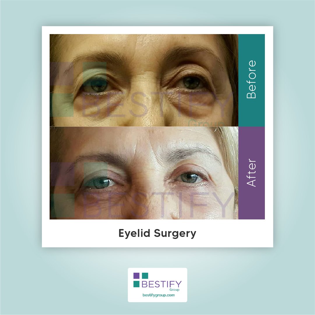 BestifyGroup's tweet image. Dreaming with eyes wide open'' she said and thanked to her doctor for an amazing result... 
We are also thanking our beloved patient Kinza for choosing us. We wish to have you again. 💜💜
#eyelid #eyelidsurgery #facelift #necklift #bichectomy #plasticsurgeon #Rhinoplasty