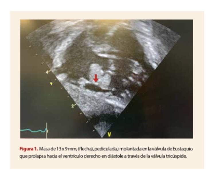 APCyCCV's tweet photo. 👶🏻Masa intracardiaca en prematuros 

#echofirst

🔍Alta sospecha de Endocarditis infecciosa 🦠
⚠️Manejo médico vs combinado con cirugía?

Aquí el reporte exitoso de una masa fúngica: abordaje y manejo 

https://t.co/TgToYl3nzO https://t.co/m83gFZX26Z