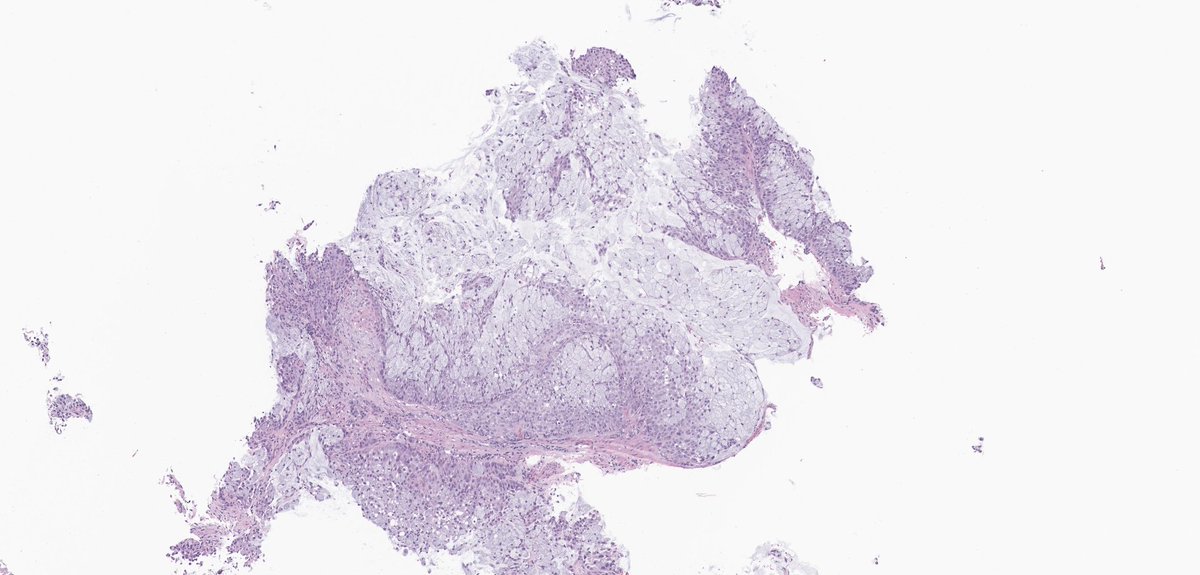 MEArslanMD's tweet photo. Esophageal mass biopsy. What would be your first differential diagnosis and which stains would be helpful in diagnosis? https://t.co/xqVia2wKHk