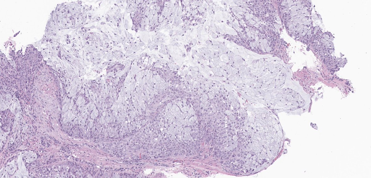 MEArslanMD's tweet photo. Esophageal mass biopsy. What would be your first differential diagnosis and which stains would be helpful in diagnosis? https://t.co/xqVia2wKHk