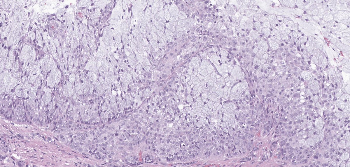 MEArslanMD's tweet photo. Esophageal mass biopsy. What would be your first differential diagnosis and which stains would be helpful in diagnosis? https://t.co/xqVia2wKHk