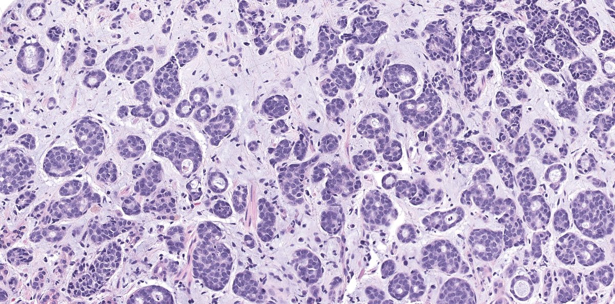 OlcaBasturk's tweet photo. This week's s/o is getting more &amp; more interesting. Look what I found in this "gastric polyp". Another zebra! Hint: Patient has a history in head&amp;neck. Anyone care to guess? #PathTwitter #gastric #stomach https://t.co/4Md2WH2Zgu