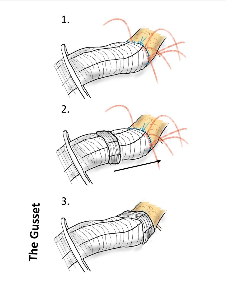 docpark's tweet photo. Sometimes, using a bit of graft is more effective than opening a very expensive hemostatic agent. I present, the gusset. #vascsurg https://t.co/7yy656ErmW