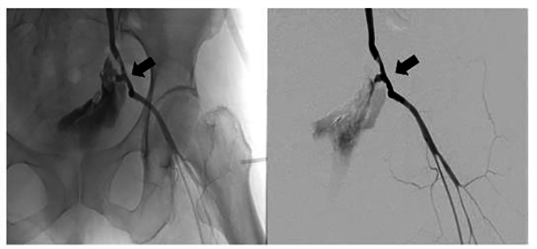 AdelaHim's tweet photo. #CEOG #IMR_Press; #OpenAccess

Welcome to read:
Life-threatening bleeding after #PelvicExenteration for recurrent #CervicalCancer: endovascular management of ruptured external iliac artery pseudoaneurysm.

👉 Please see more detail at:
https://t.co/LlD9SlB3wO https://t.co/VEGVDt21dR