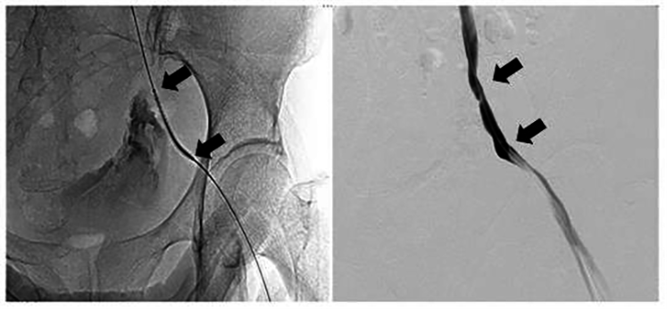 AdelaHim's tweet photo. #CEOG #IMR_Press; #OpenAccess

Welcome to read:
Life-threatening bleeding after #PelvicExenteration for recurrent #CervicalCancer: endovascular management of ruptured external iliac artery pseudoaneurysm.

👉 Please see more detail at:
https://t.co/LlD9SlB3wO https://t.co/VEGVDt21dR