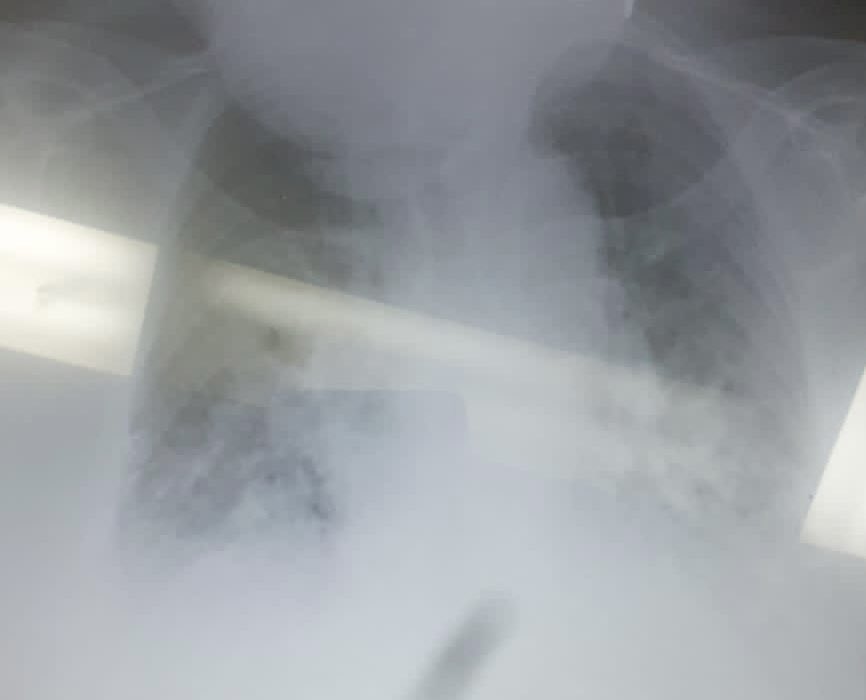 mirvatalasnag's tweet image. Enjoy #WorldCup2022 @FIFAWorldCup @SCAI @PCRonline 

Are we all seeing an uptick in #STEMIs or only countries where ⚽️ is a national sport?

@lamelaspablo @RodrigoBagur @omendiz @nolanjimradial @sbrugaletta @kfaraidy @ANazmiCalik @KardiologieHH @Steph_Achenbach @SilCastelletti