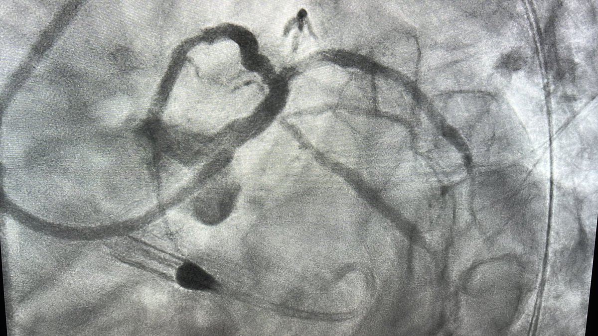 mirvatalasnag's tweet image. Enjoy #WorldCup2022 @FIFAWorldCup @SCAI @PCRonline 

Are we all seeing an uptick in #STEMIs or only countries where ⚽️ is a national sport?

@lamelaspablo @RodrigoBagur @omendiz @nolanjimradial @sbrugaletta @kfaraidy @ANazmiCalik @KardiologieHH @Steph_Achenbach @SilCastelletti