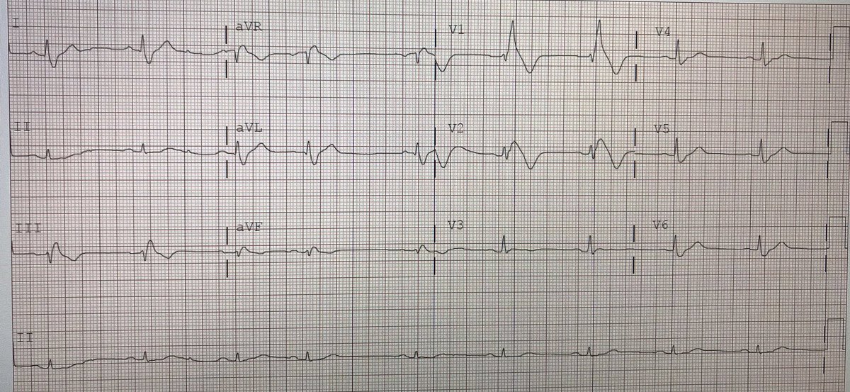 jvillacastin's tweet photo. Este varón de 37 años refiere haber perdido el conocimiento mientras estaba tumbado en la cama leyendo. La exploración es normal. No toma medicamentos. Llama la atención el ECG. Se le realiza un eco que es también normal. Crees que lo debemos ingresar? https://t.co/0n7rMkgePe