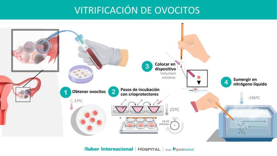 Los especialistas en reproducción asistida de nuestro hospital atienden cada vez a más mujeres que se interesan por conocer su reserva ovárica y por las opciones disponibles para vitrificar sus óvulos. Descubre cómo es este proceso a continuación my.mtr.cool/zbavwcidej