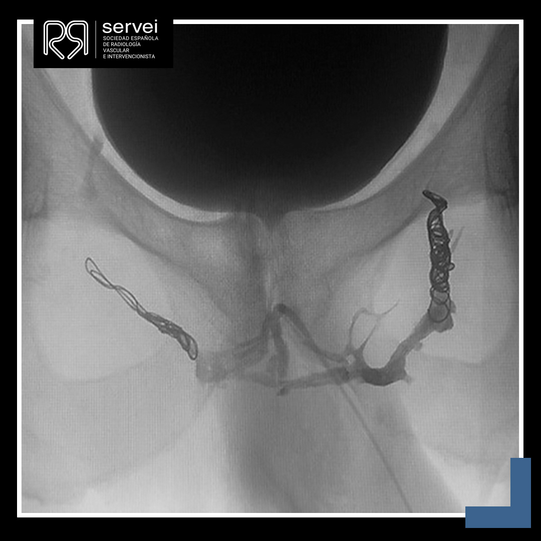 SERVEISoc's tweet photo. ❄️ ¡CASO CLÍNICO DICIEMBRE!
Terminamos el año con este caso de embolización con ONYX del plexo periprostático 🍆 🙊.
¡Gracias 🤗 al Dr. @IInsaustiGorbea del Hosp. Univ. de Navarra por compartirnos el caso!
👉 https://t.co/US4qWRCZNb
#RadiologíaIntervencionista #FOAMIR #Irad https://t.co/dsoi4Y5TrM