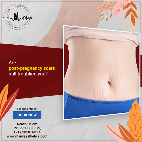 ManyaAesthetic's tweet photo. Stretch marks are an integral part of pregnancy and it is best to let nature run its course after doing everything to prevent it or treat it safely. 

📞+91 7799888879
🌐 https://t.co/CCbGorZLqC

#manyaesthetics #scars #pregnancyscars #scarproblem #lasertreatment #skincare https://t.co/DdNpgHP0K7