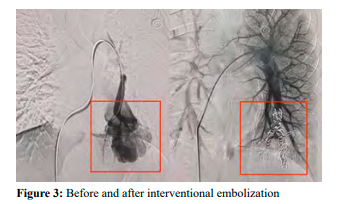 AnnalsMedical's tweet photo. https://t.co/HLgAOge6A0
#A 16-Year-Old Girl with Hereditary Hemorrhagic Telangiectasia https://t.co/9OvFiMkHl5