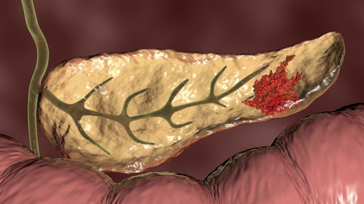 MedwebL's tweet photo. MedWeb Blog of the day ☀️

New Genetic Culprit Suspected In The Onset Of Pancreatic Cancer

New research out of VCU Massey Cancer Center points to the...

Read full: https://t.co/ghdRNBoE3X

#research #pancreaticcancer #openaccess #cancer #medicalblogs #MedTwitter #medicalnews https://t.co/1wcRsqanZ9