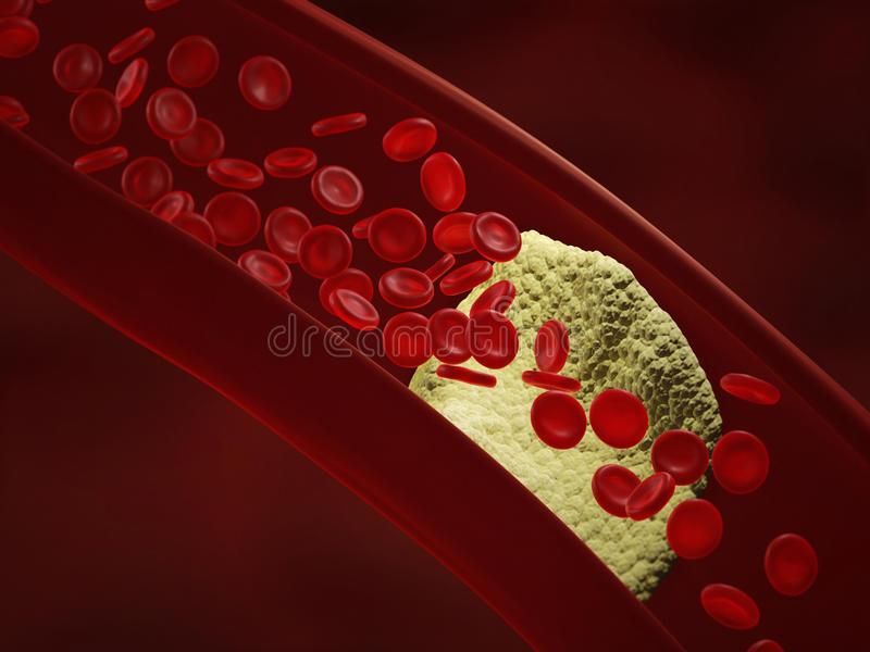 Avgen_Dx's tweet photo. Beneficial evolutionary mutation. 

A #gene called #ApoA1M encodes a #protein that removes #cholesterol from the walls of #arteries and works as an #antioxidant to prevent #inflammation associated with #arteriosclerosis. 
#Cardiology #strokeawareness #health https://t.co/xEatemGvHv