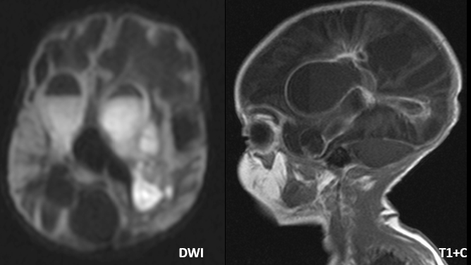 drmankad's tweet photo. Tip of the day 💡: When the clinician asks you, 'is there active bacterial infection here?' rely on the diffusion weighted imaging (pus restricts) compared to the post contrast T1. https://t.co/bSewRWXK7p