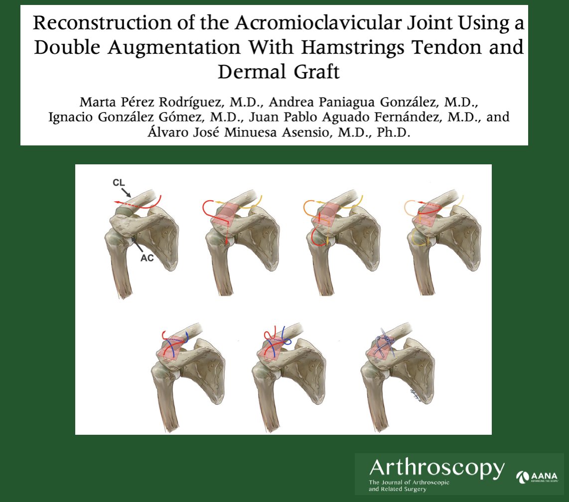 This article describes a technique for reconstruction of the coracoclavicular ligaments as well as the acromioclavicular ligament complex using a hamstrings tendon allograft and dermal graft

ow.ly/xEyK50LNTsX